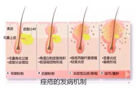 长知识！关于成人痘最全面的解决方案