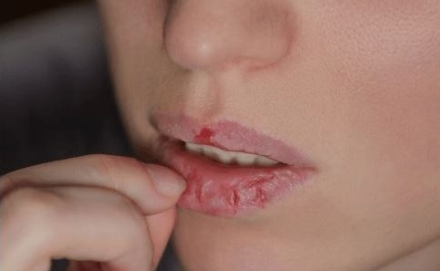冬季唇部护理 不可轻忽！冬季嘴唇最怕的事